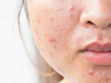 Pimple-Like Bumps such as Papulopustular Rosacea